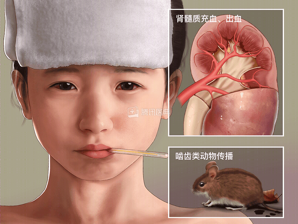 科普｜安第斯病毒：可人际传播的汉坦病毒“家族”成员